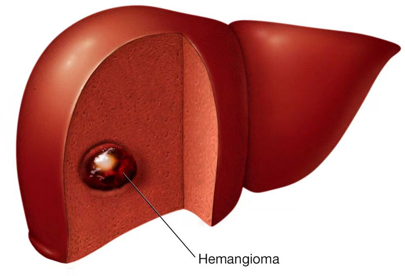 liver-hemangioma_drhossein_ziaei