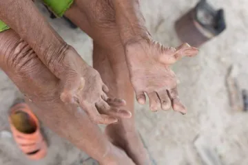 بیماری جذام