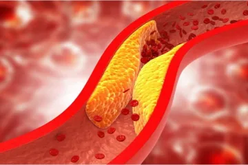 آترواسکلروز