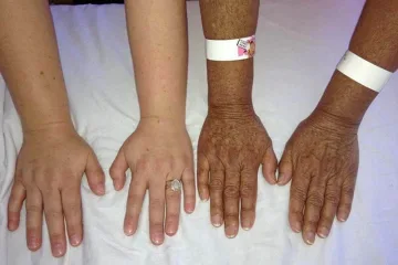 آدیسون