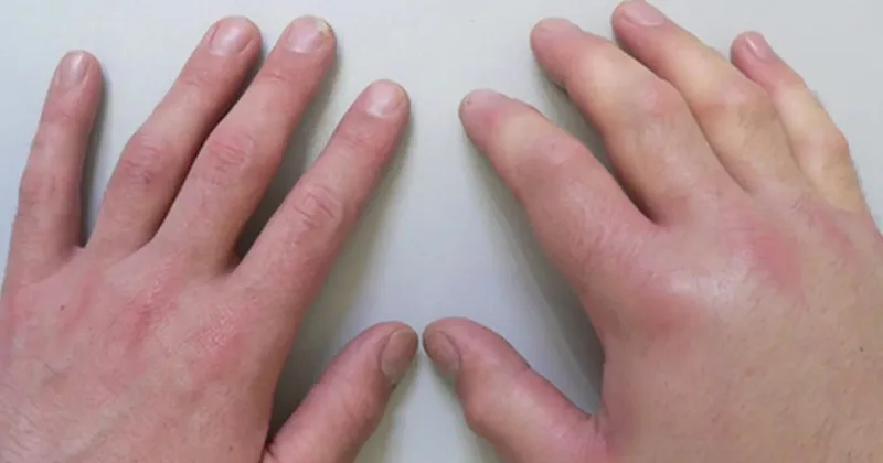 swelling1