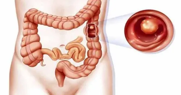 انواع-مختلف-بیماری_های-التهابی-روده-شامل-چه-مواردی-است؟