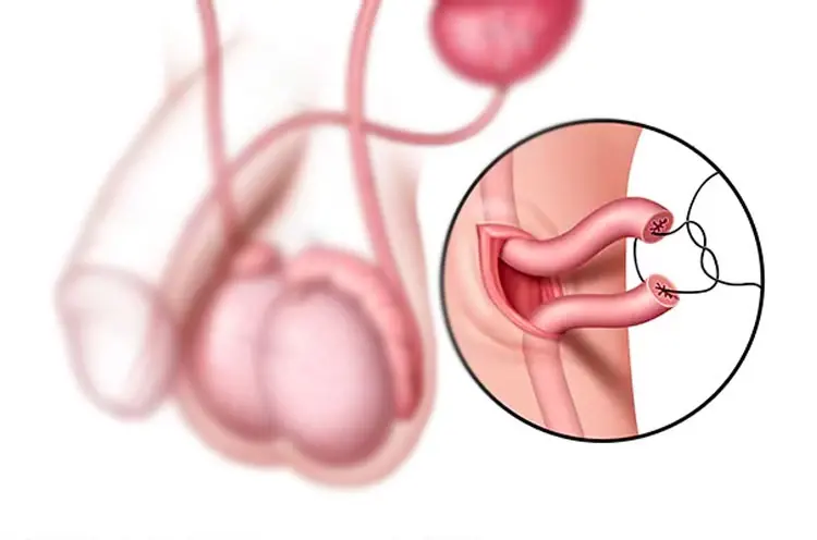 vasovasostomy1_1675140646_main