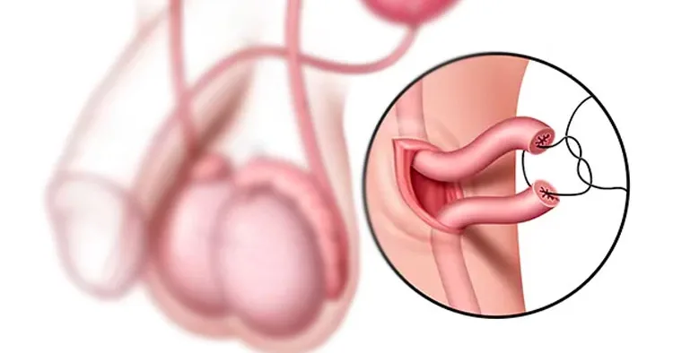 vasovasostomy1_1675140646_main