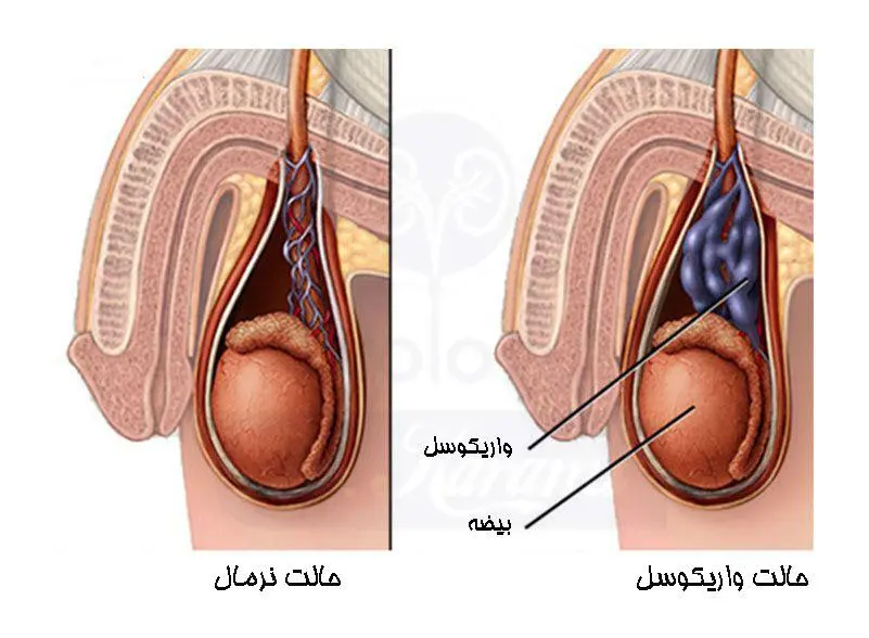 urologykarami-varicocele