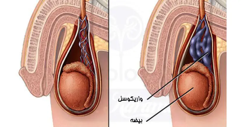 urologykarami-varicocele