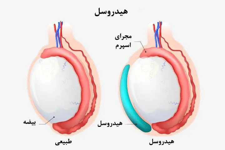 عوارض-ناشی-از-هیدروسل-h2