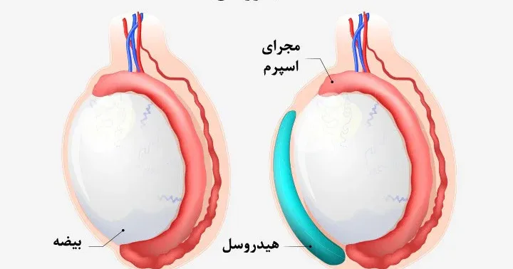 عوارض-ناشی-از-هیدروسل-h2