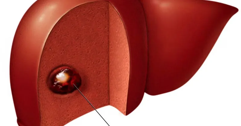 liver-hemangioma_drhossein_ziaei