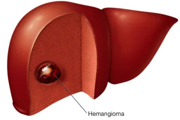 liver-hemangioma_drhossein_ziaei