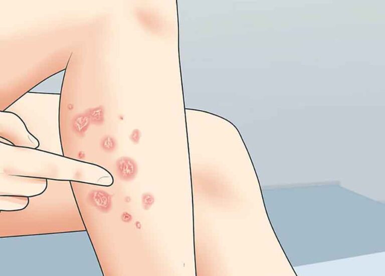 بیماری صدفی