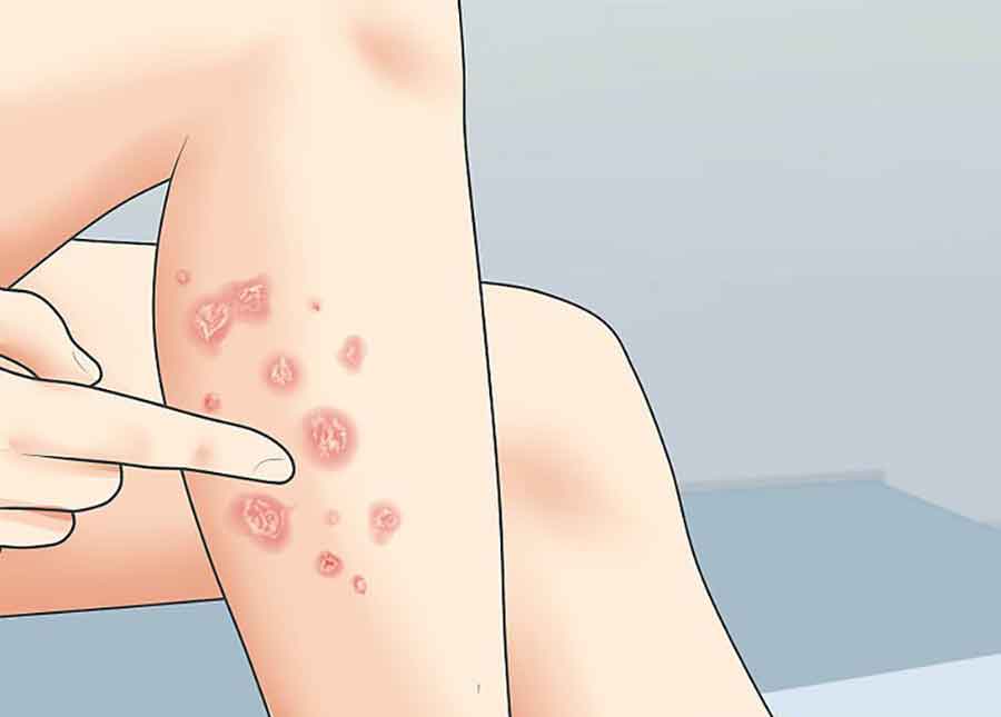 بیماری صدفی چیست؟